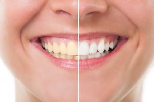 5 foods that can whiten your teeth