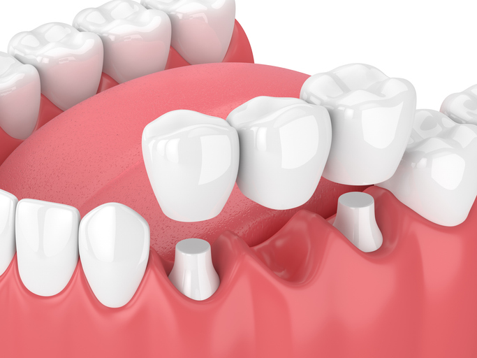 3d render of jaw with dental bridge