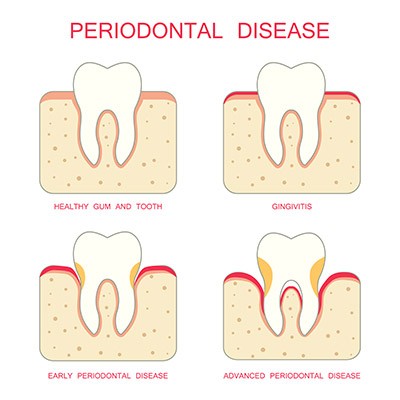 Periodontal Disease